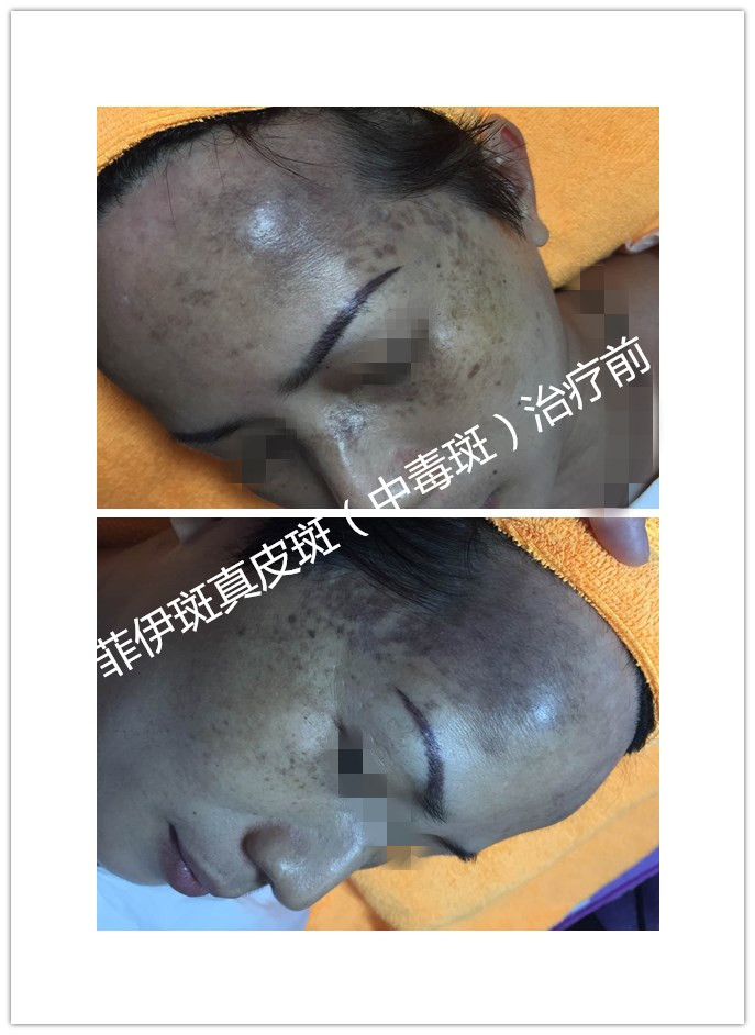或者在出生验微量元素重金属偏 高者.还有常化浓妆者.